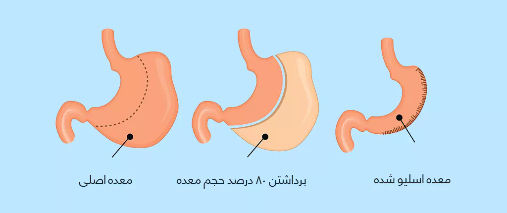 اسلیو معده: همه چیز درباره جراحی کاهش وزن و مزایای آن