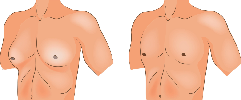 ژنیکوماستی آقایان: علت، علائم و روش‌های درمان